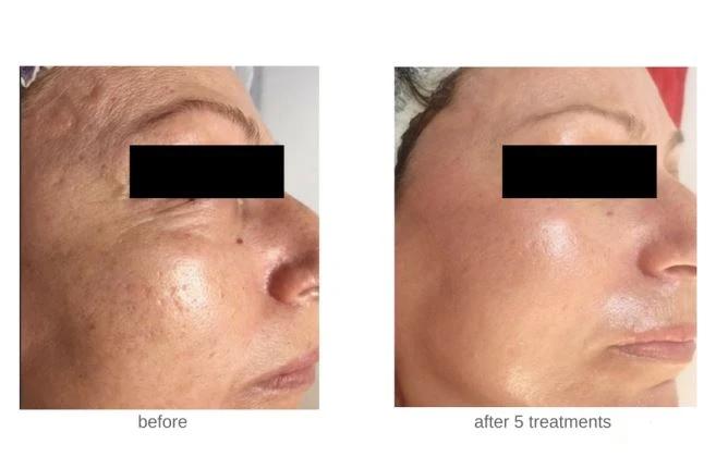 microneedle-fractional-rf before after4
